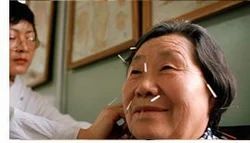 Geriatirc Acupuncture Treatment