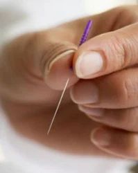 Acupuncture Treatment