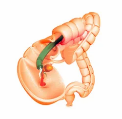 Endosurgery Treatment