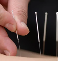 Chinese Acupuncture Treatment Service