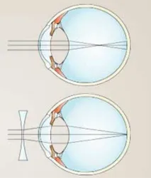 Ayurvedic Treatment For Degenerative Myopia